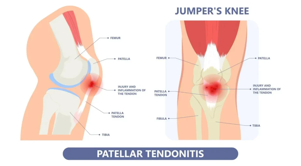 masāža patellārā tendinopātija
